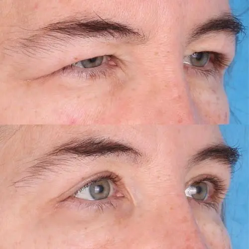 انواع بلفاروپلاستی; مزایا و عوارض آن (2)