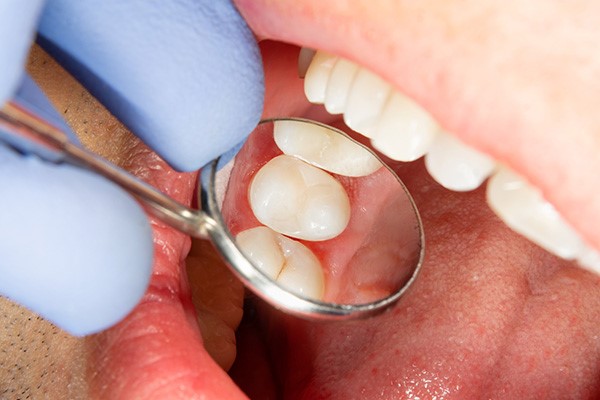 حساسیت دندان  (3)