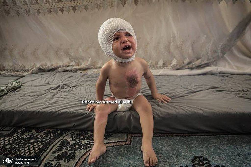 سوختگی شدید کودک فلسطینی بر اثر حمله صهیونیستها (3)