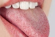 چه بیماری‌هایی باعث خشکی دهان می‌شود؟