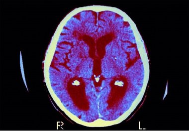 فراموشی زودهنگام در کودکان؛ پای سرب در میان است
