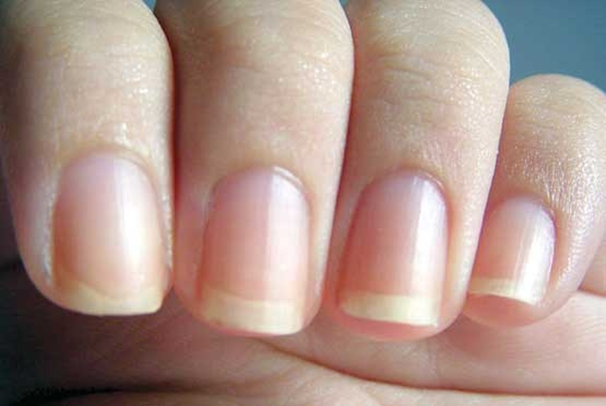علت لکه‌های سفید روی ناخن ها+ راه درمان 