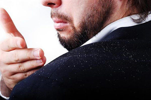 چرا شوره سر ایجاد می‌شود؟ + راه درمان