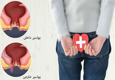 بواسیر داخلی و خارجی و راه درمان قطعی انواع هموروئید