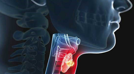 آشنایی با علائم سرطان حنجره