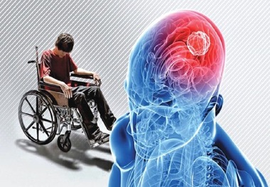 ام‌اس؛ بیماری جوانان با ۱۰ نشانه خاموش
