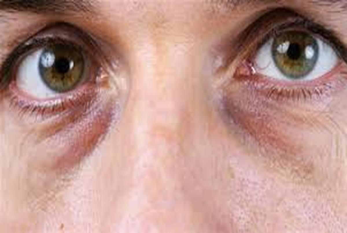 علت سیاهی زیر چشم چیست؟ + راهکارهای درمان