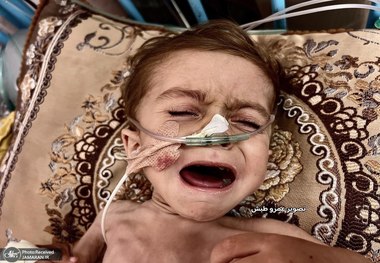 وخامت وضعیت سلامت کودک سه‌ساله غزه‌ای بر اثر سوءتغذیه و محاصره + عکس های دردناک