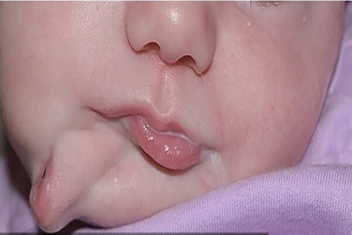 جراحی نوزادی که با دو دهان متولد شده بود + تصاویر