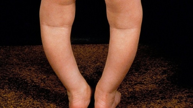 همه آنچه لازم است از پای پرانتزی کودک بدانید