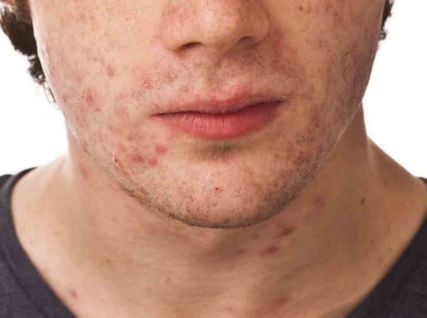 آکنه یا جوش در بزرگسالان؛ عوامل و راه‌های درمان