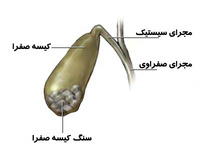 سنگ کیسه صفرا در چه کسانی شایع تر است؟