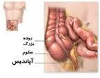 همه چیز درباره آپاندیسیت