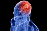 آنچه باید درباره تومورهای مغزی بدانید