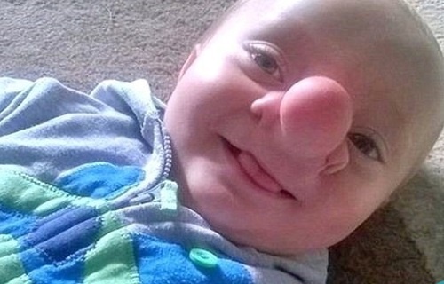 این بیماری ناشناخته مغز را از سرتان بیرون می‌کشد+ تصاویر
