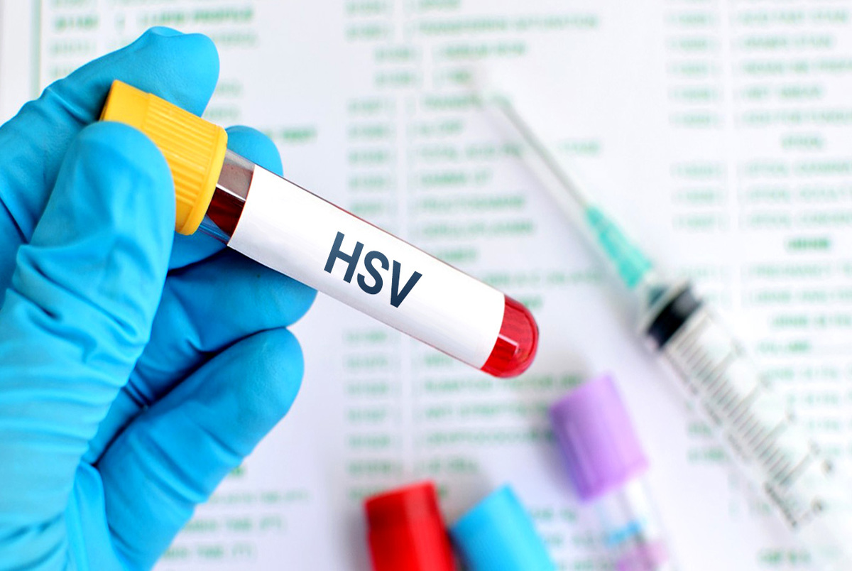 مقابله با ویروس HSV با استفاده از فناوری‌نانو