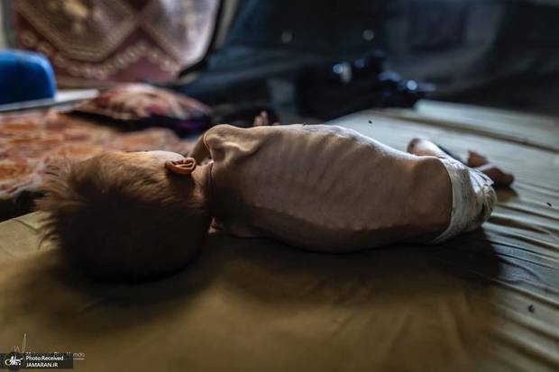 عکس‌های دلخراش از غزه/ کودک ۱.۵ ساله فلسطینی در حال مرگ از گرسنگی است