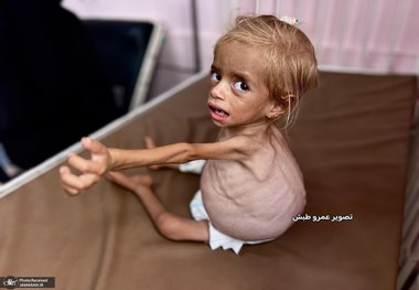تصاویر دردناک از کودک دو ساله غزه‌ای در مراحل بحرانی سوءتغذیه به دلیل قحطی