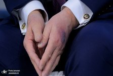 پزشک دیک چینی: ترامپ به نظر سالم نمی‌رسد؛ ابهام درباره تورم پا، کبودی دست‌ها و آزمایش‌های پیشرفته