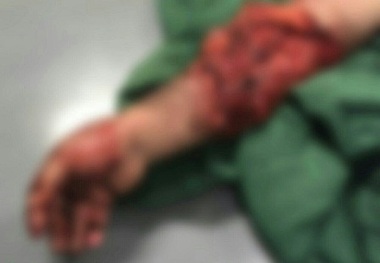 میله 60 سانتی از دست مرد 45 ساله در قزوین خارج شد