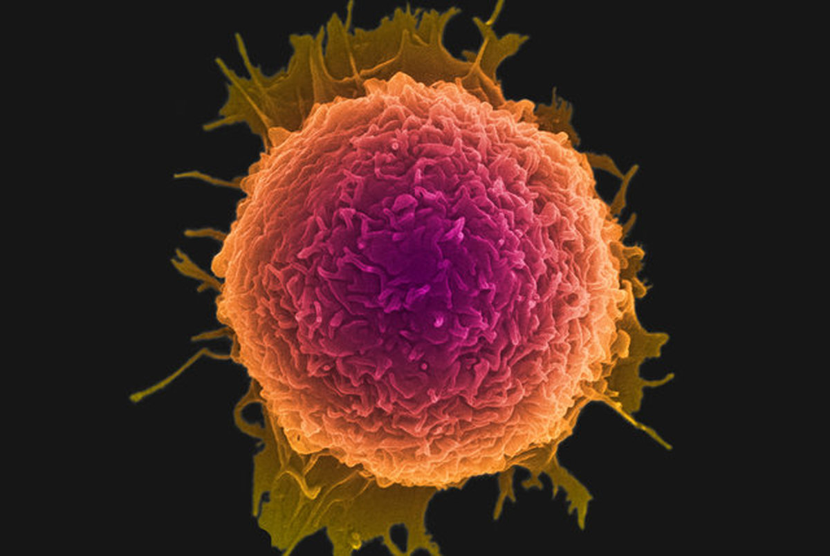 کشف روش جدید تبدیل سلول های سرطانی به سلول های چربی
