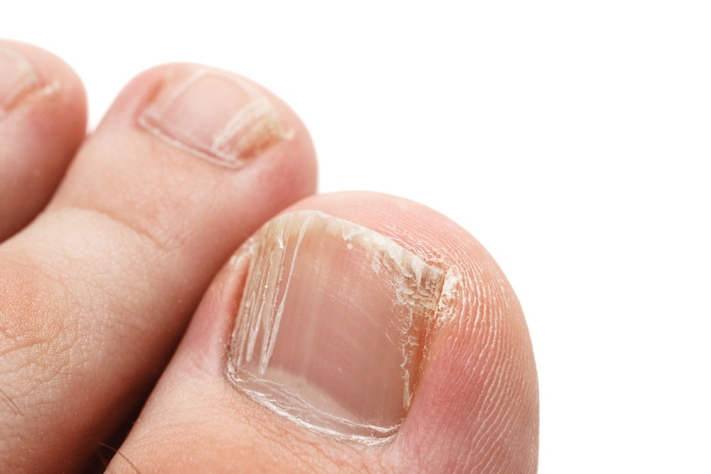 دلایل ایجاد لکه‌های سفید روی ناخن‌ها و بیماری‌های مربوط به آن