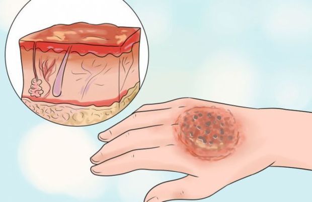 سوختگی با مایعات داغ بیشترین موارد سوختگی‌ در مشهد است