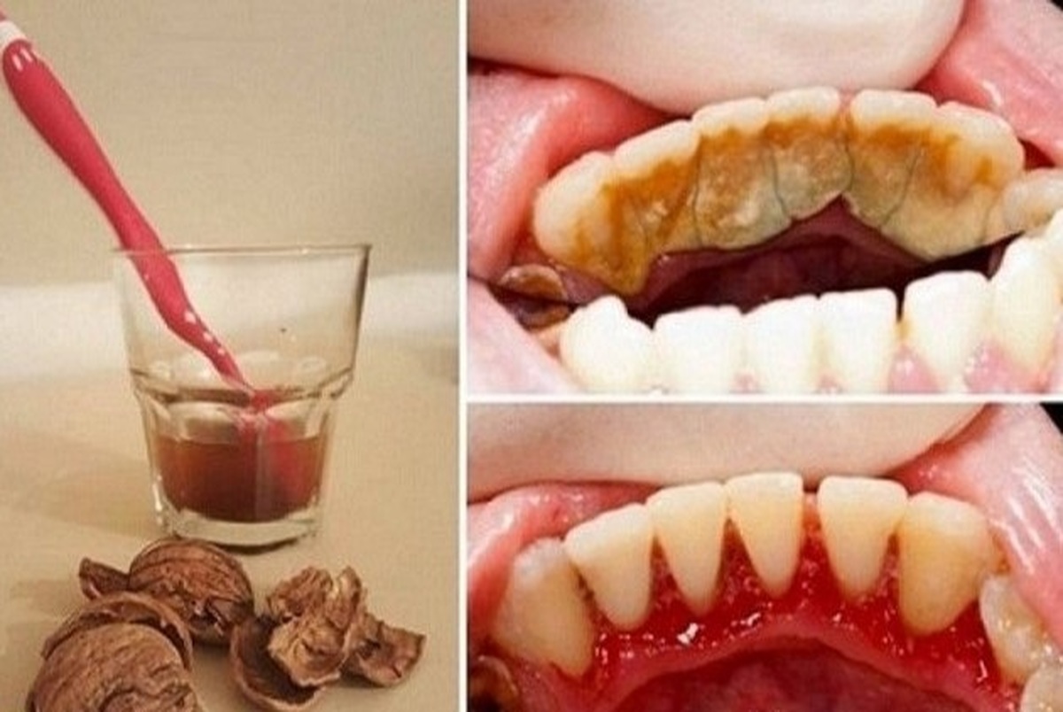 چگونه «جرم دندان» را بدون هزینه از بین ببریم؟