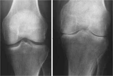 نشانه‌های بیماری "رماتیسم"