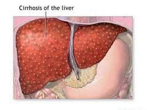 علل بروز "سیروز کبدی" چیست؟