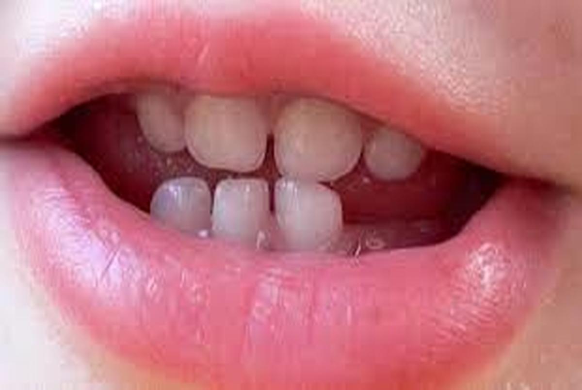 بهترین زمان معاینه ارتودنسی دندان کودکان