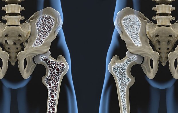 بیماری خاموشی که زنان را بیشتر از مردان تهدید می‌کند