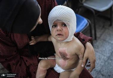 سوختگی شدید کودک فلسطینی بر اثر حمله صهیونیست‌ها - هشدار تصاویر دردناک