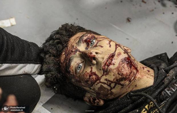 چهره حیرت زده کودک فلسطینی که در حمله اسرائیل زخمی شد