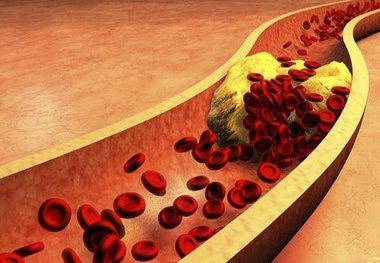 میزان بالای هورمون تیروئید یکی ازعوامل بیماری های قلبی