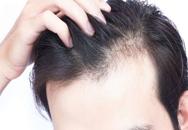 
اگر ریزش مو دارید این مکمل را مصرف کنید