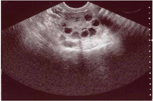 فیبروم چیست؟ + راه های درمان 