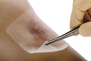 ترمیم زخم های دیابتی با کمک زخم‌ پوش‌های نانو لیفی