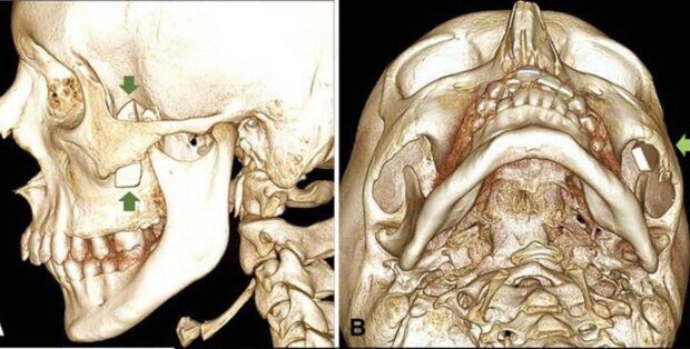 گیر کردن یکماهه خرده شیشه زیر استخوان گونه یک نوجوان