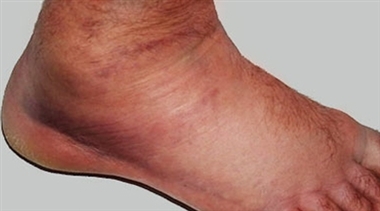 چه چیزی باعث تورم پاها در تابستان می‌شود؟ + راه های مقابله