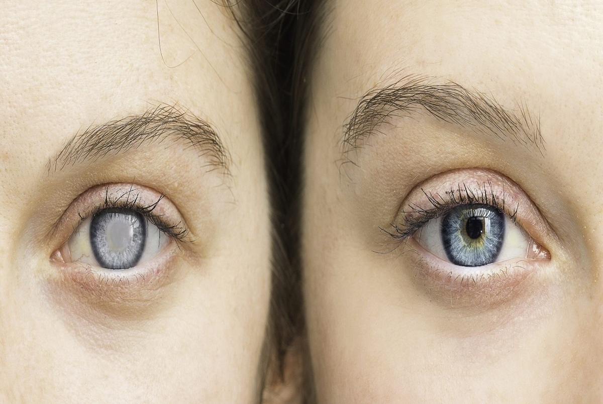 رابطه میان خشکی چشم و آسم چیست؟
