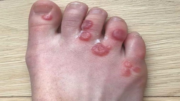 چگونه تاول خونی پا را درمان کنیم؟
