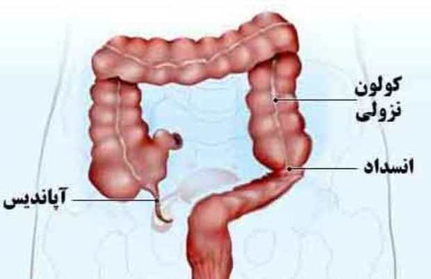 نگاهی به پیچیدگی تشخیص بیماری آپاندیس