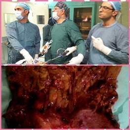عمل جراحی توتال کاستر کتومی به روش لاپاراسکوپی در بیمارستان آیت الله کاشانی با موفقیت انجام شد